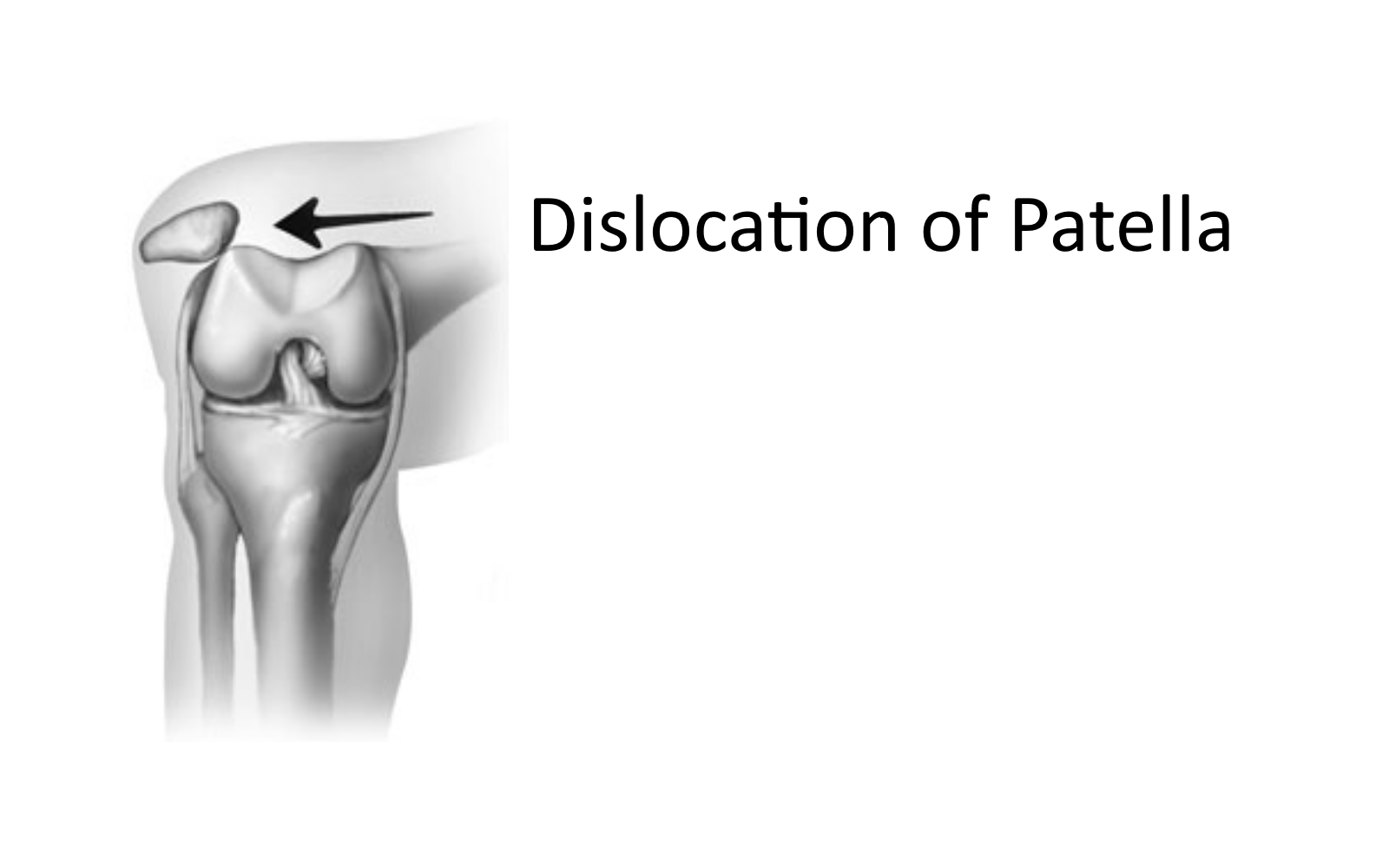 patella dislocation rehab